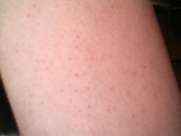 大腿和小腿干处有红色点点是什么原因?