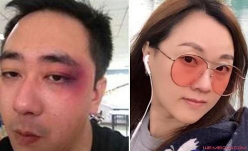 他在社交平台上公布了被妻子家暴的照片,看起来脸上被打得青一紫一片